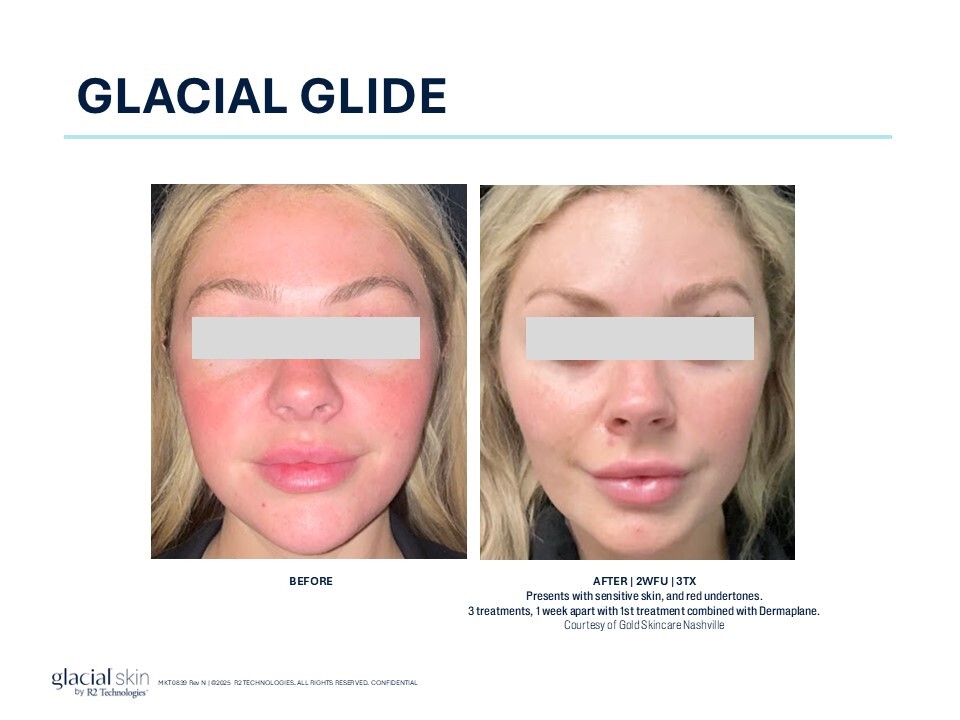 Image of a patient with rosacea as a before and after Glacial Glide Treatment
